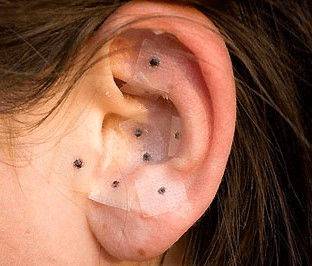 acupuntura sin agujas